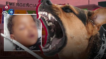 Reconstruyen Rostro De Niño De Dos Años Tras Ser Mordido Por Un Perro Salvaje En Santiago