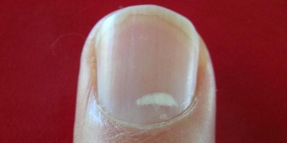 ¿Por qué salen puntos blancos en las uñas? - Cachicha.com